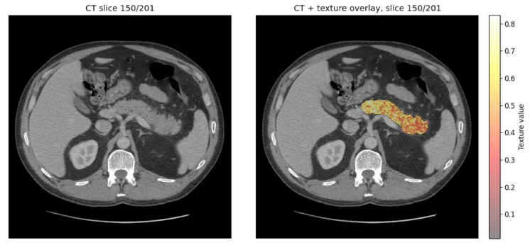 AI spoort alvleesklierkanker jaren eerder op in CT-scan / Nieuws | FOK.nl