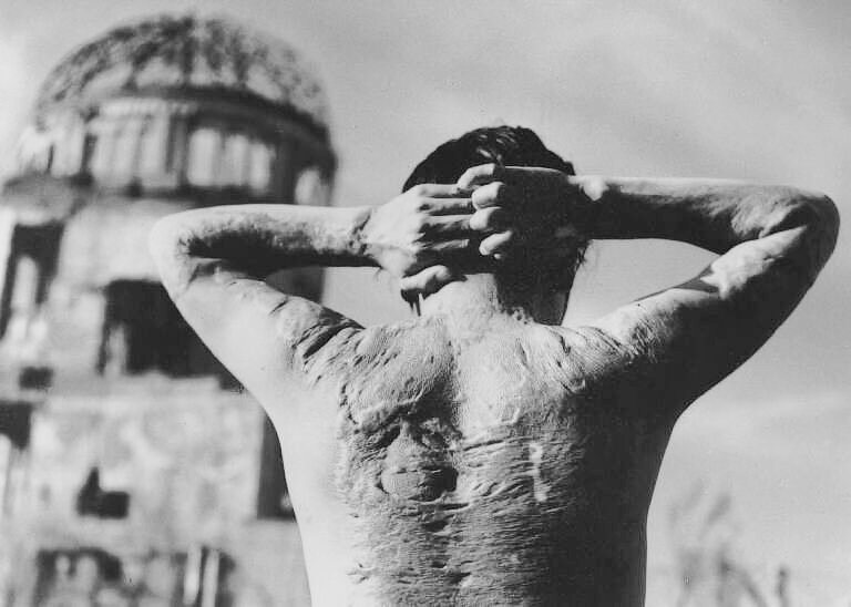 Overlevende na atoombom op Hiroshima augustus 1945 (@Werner Bischof)